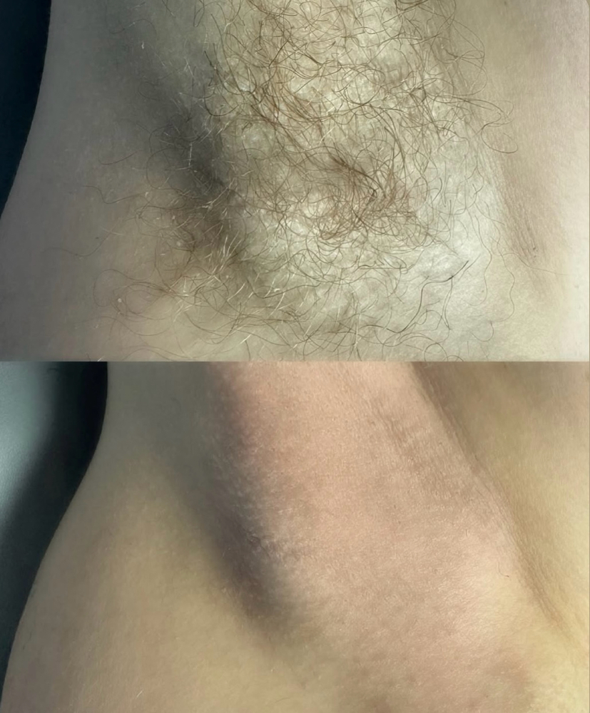 Underarm Wax at Dreamy Eyes And Skin in Palm Springs, FL