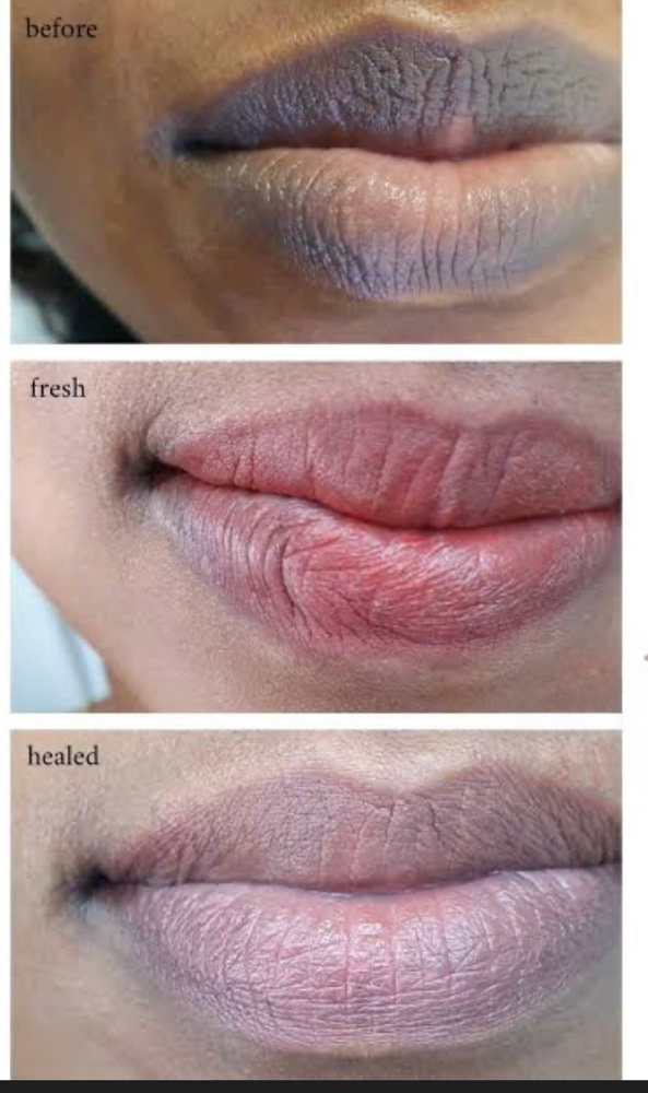 Dark Lip Neautralizatiom