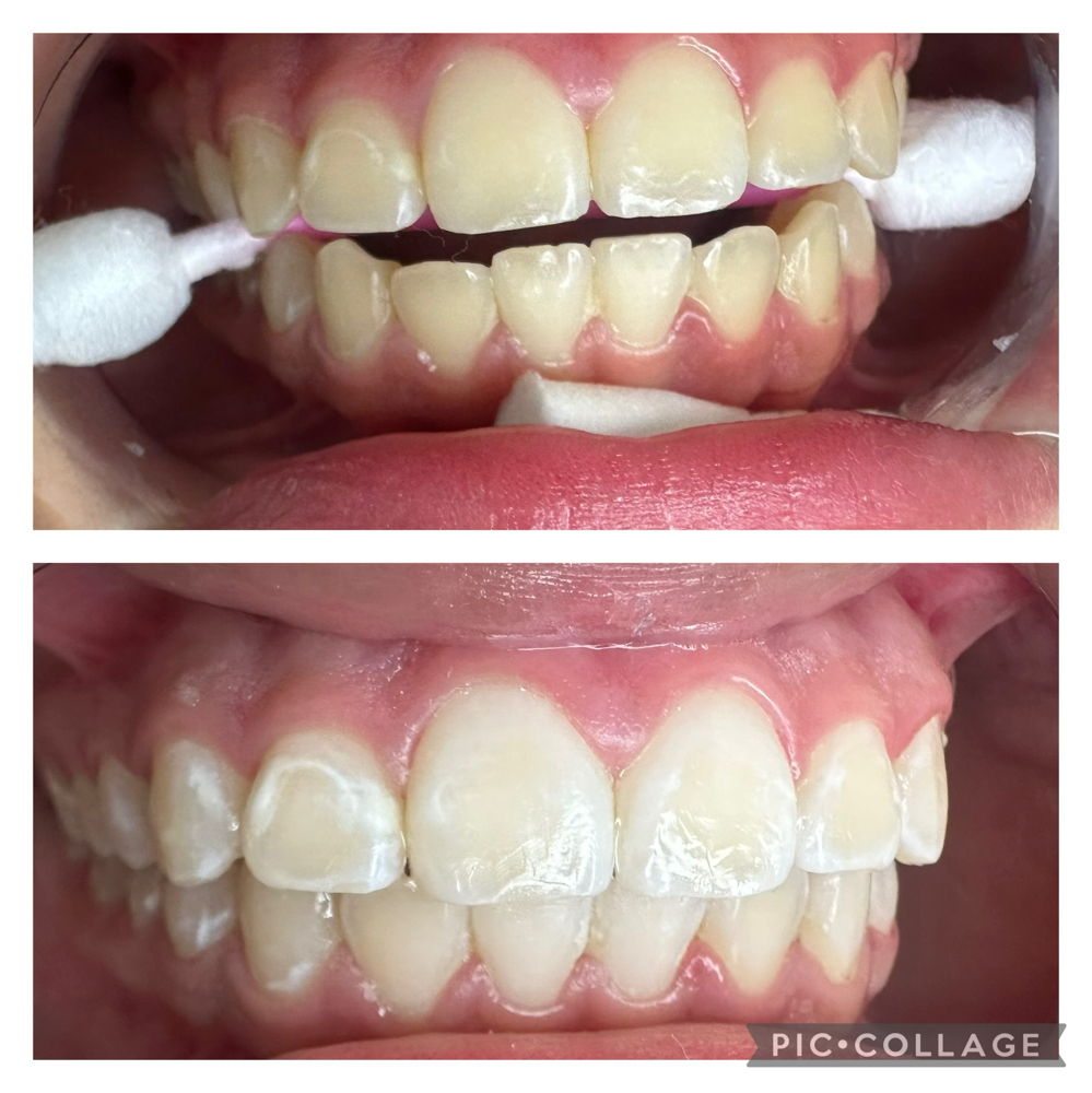 60 Minute Follow Up Teeth Whitening