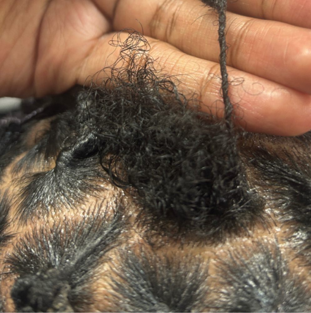 Loc Reconstruction at BraidzbyJ in Abilene, TX