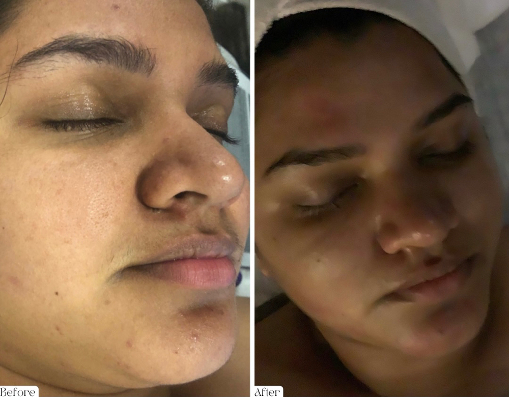 Acne Facial