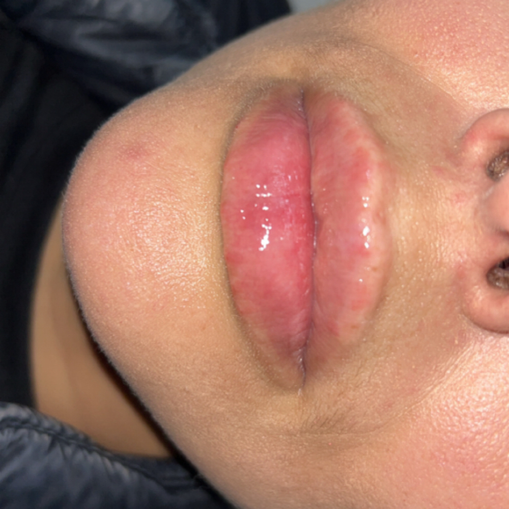 Micro Needling Lip Filler .6ml at Kat Marie Aesthetics in Humble, TX