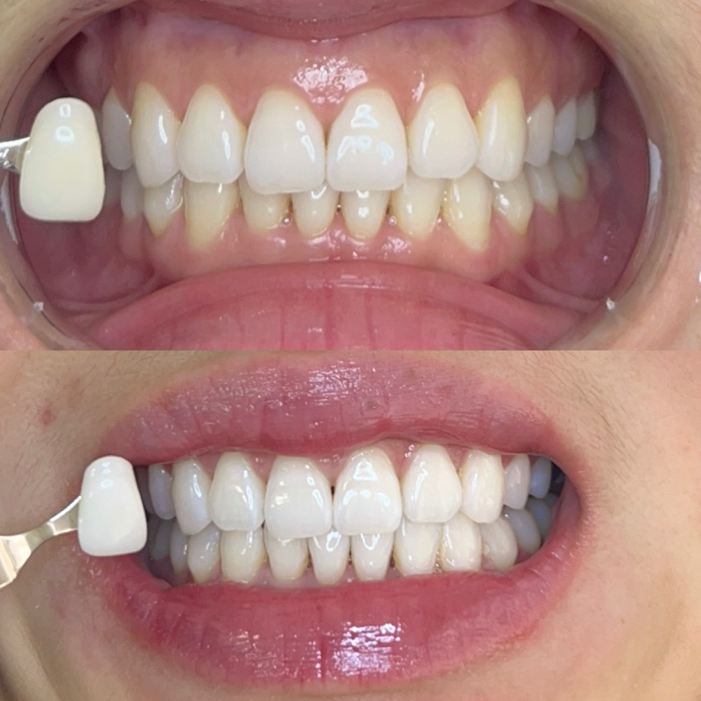 Retruning Clients Boost Treatment at Fairywhite Teeth Whitening in Artesia, CA