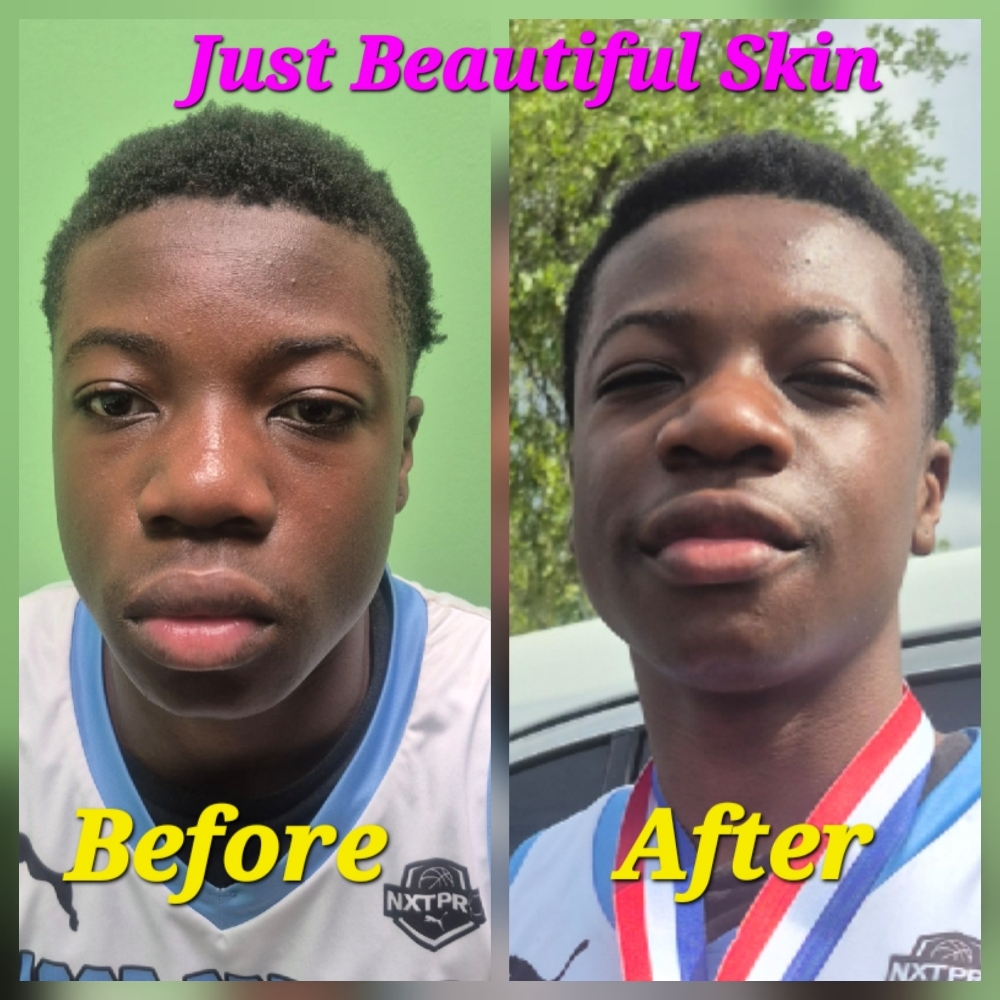 💥 Teen Acne Control Facial (Age at JUST BEAUTIFUL SKIN in Goose Creek, SC