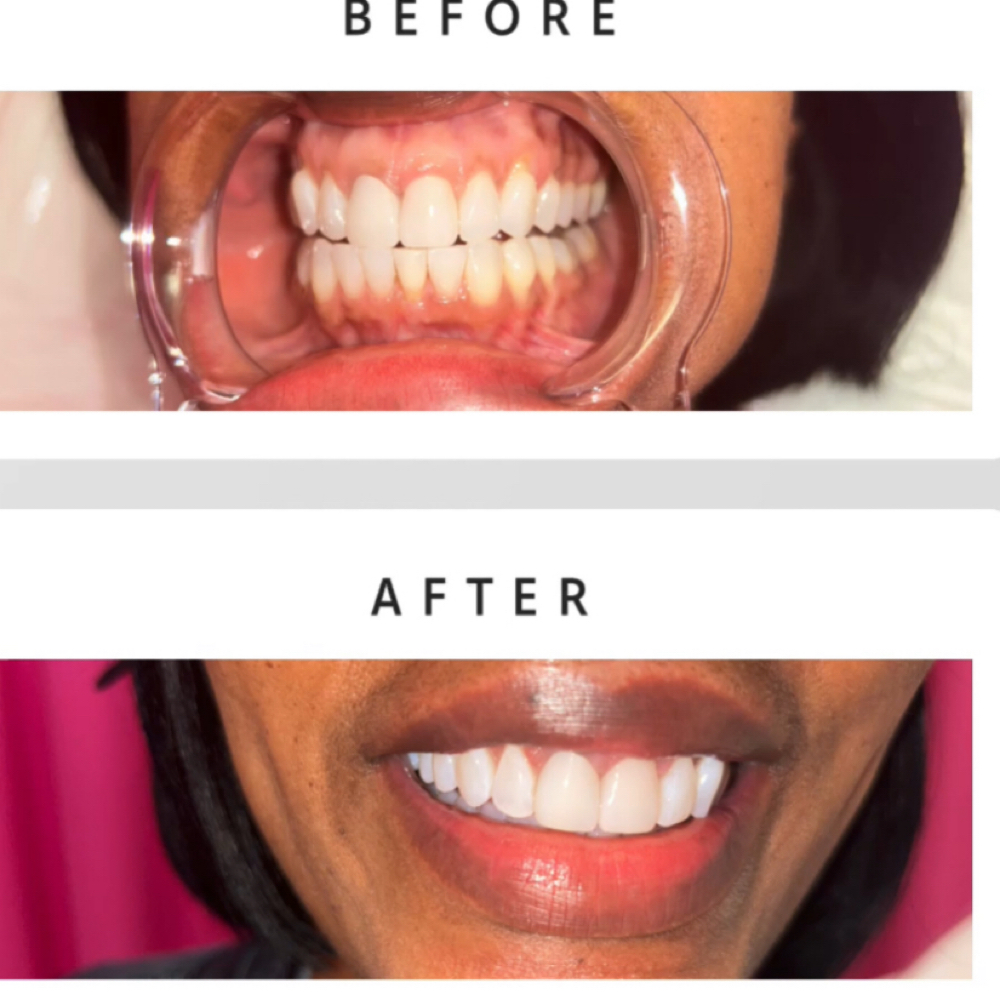 Love Your Smile + Enamel Booster