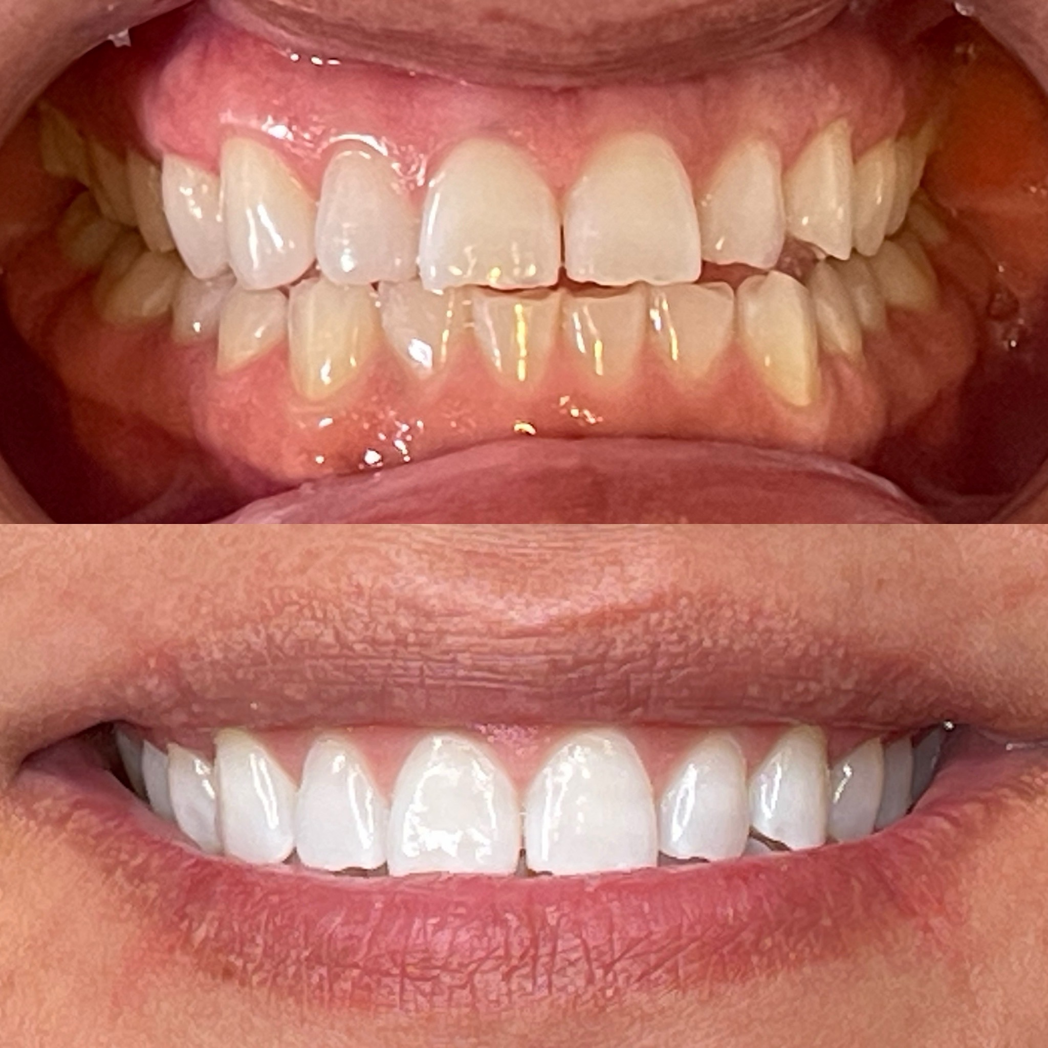 60 Minute Teeth Whitening at Smiles By Ali✨ in Arlington, TX