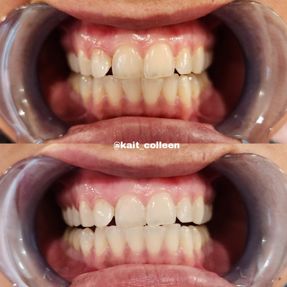 Teeth Whitening- 20 Min Session