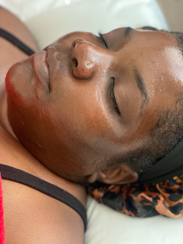 Chemical Peel Level I