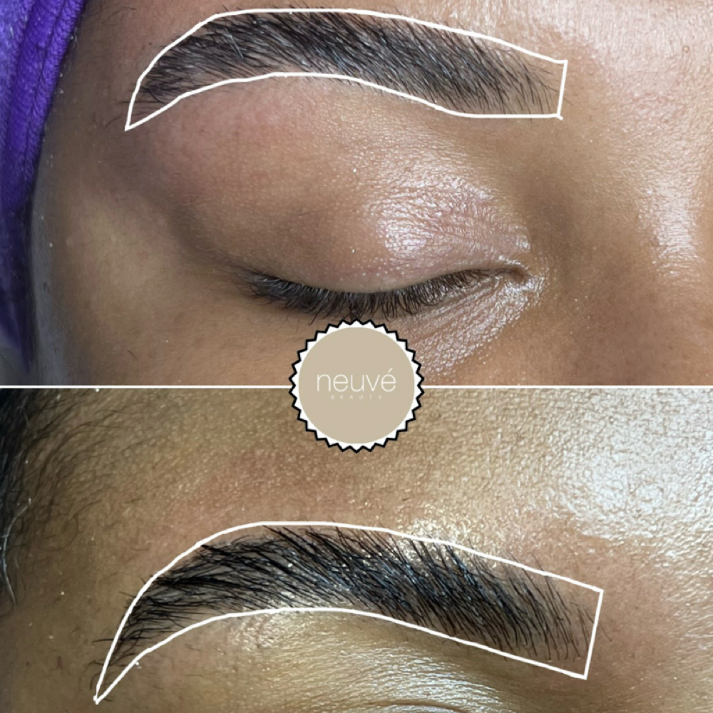 Brow Reconstruction (Microneedling) at Neuve Beauty in Miami, FL