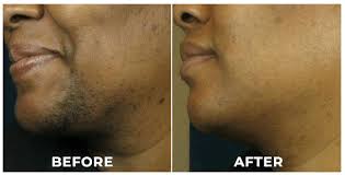 Facial Hair Removal