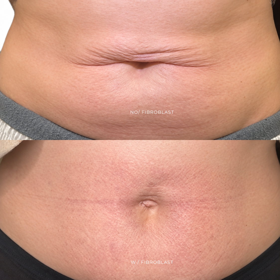 FIBROBLAST | ABDOMEN at EROXSPA in Houston, TX