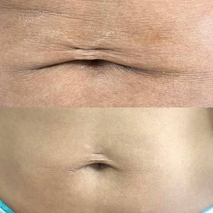 FIBROBLAST ABDOMEN