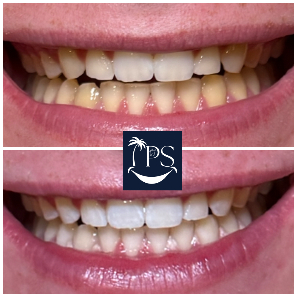 SIGNATURE REFRESH at Island Pro Smiles Mobile Teeth Whitening in Sandwich, MA