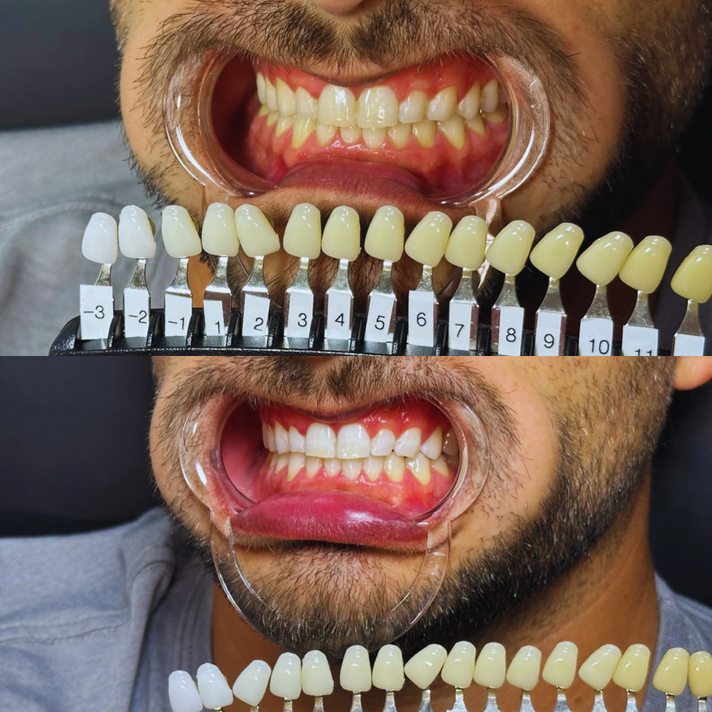 Mobile Teeth Whitening