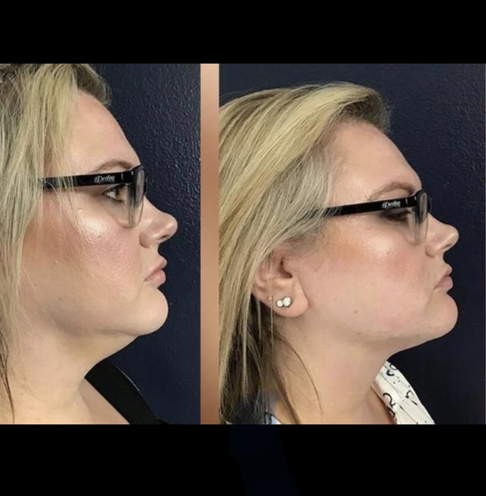 Slimming Tightening Face