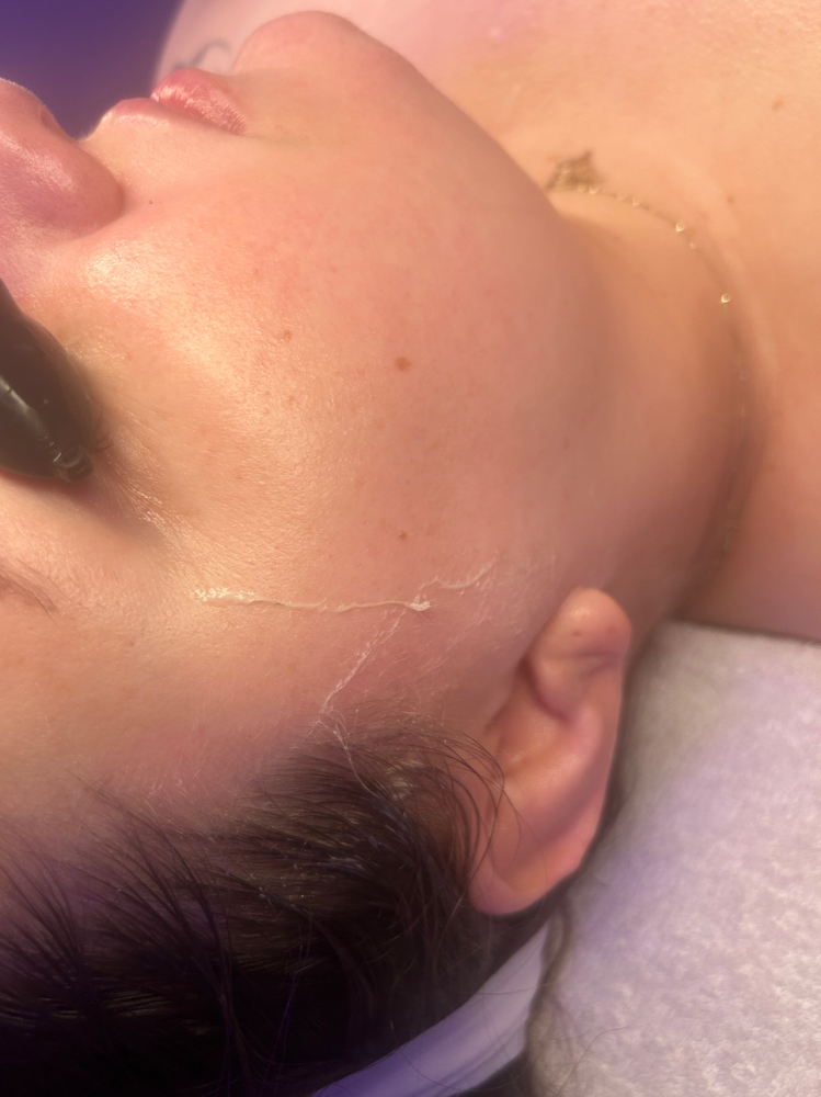 Dermaplaning Only