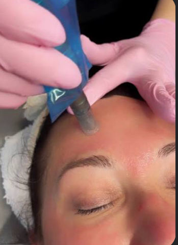 Add-on Microneedling