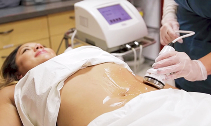 Ultrasound Cavitation