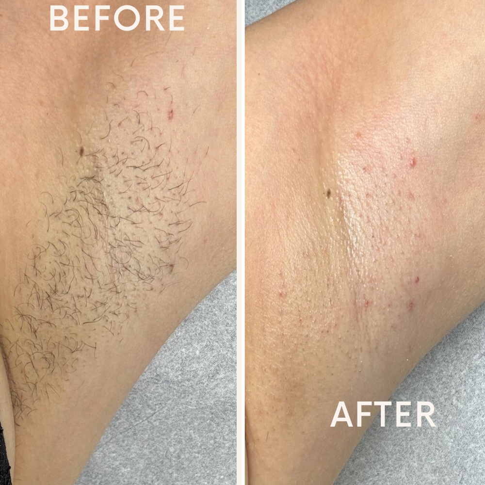 Underarms Wax