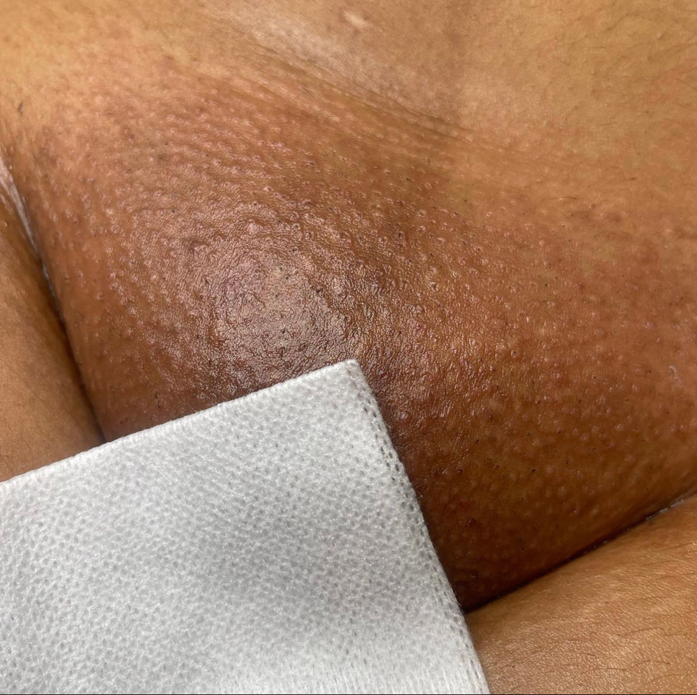 Brazilian wax
