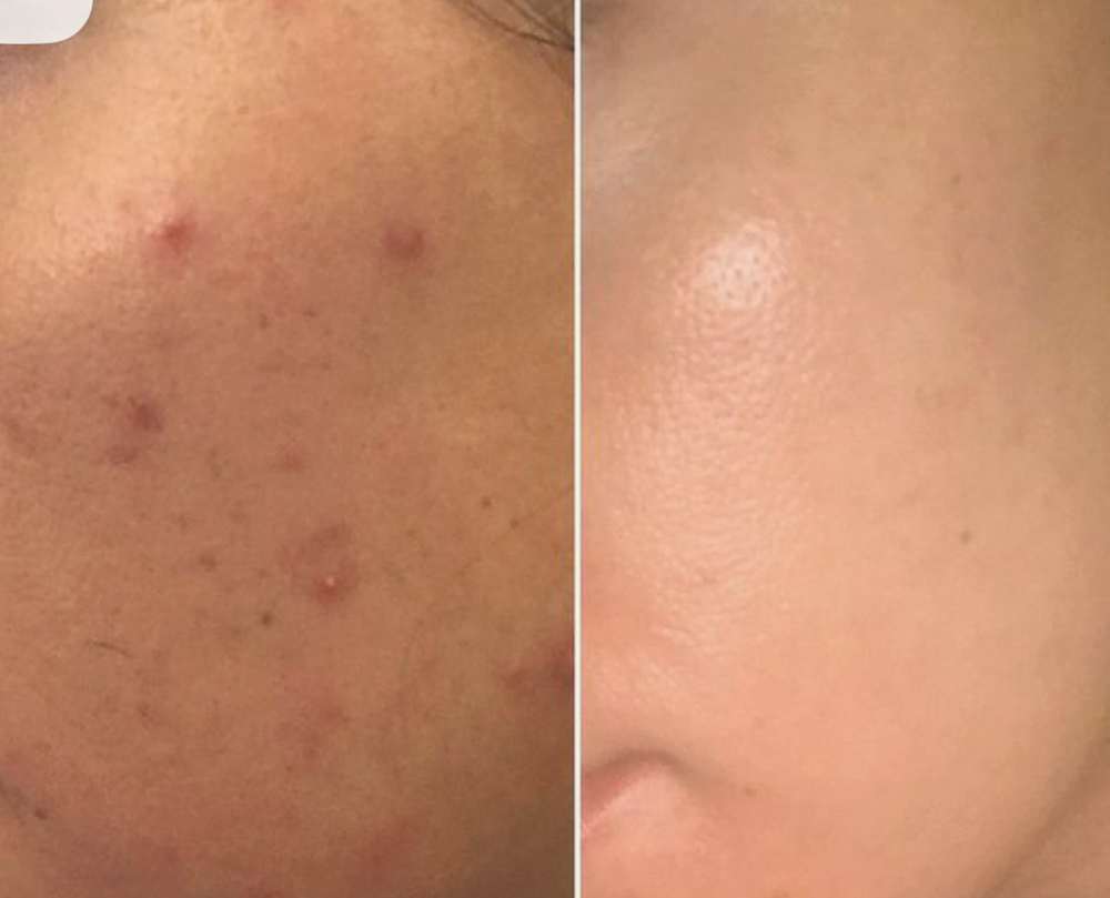 Acne Treatment Peel
