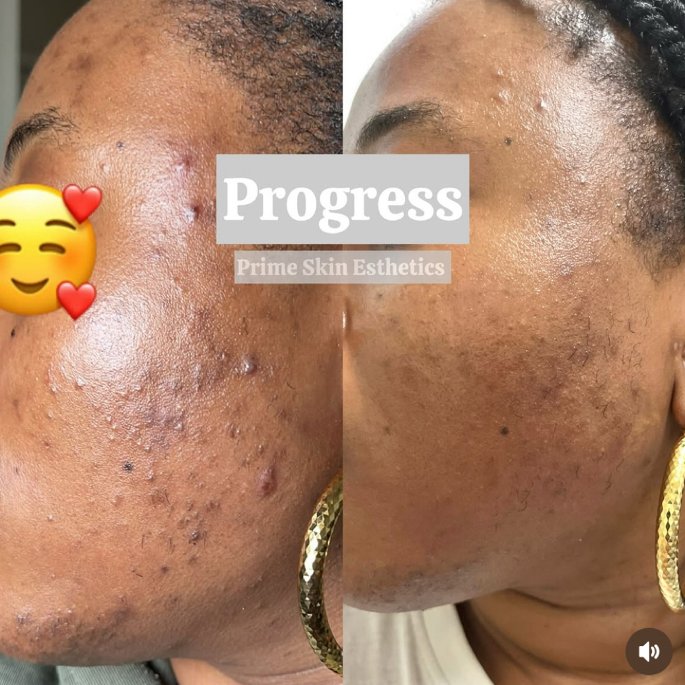 SQT ACNE FACIAL at Prime Skin  Esthetics in Belleville, NJ