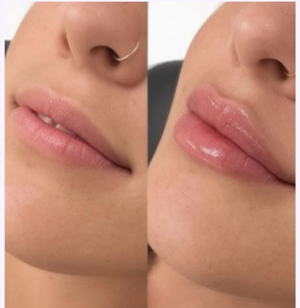 Lip Filler at renew + radiate in Kamiah, ID
