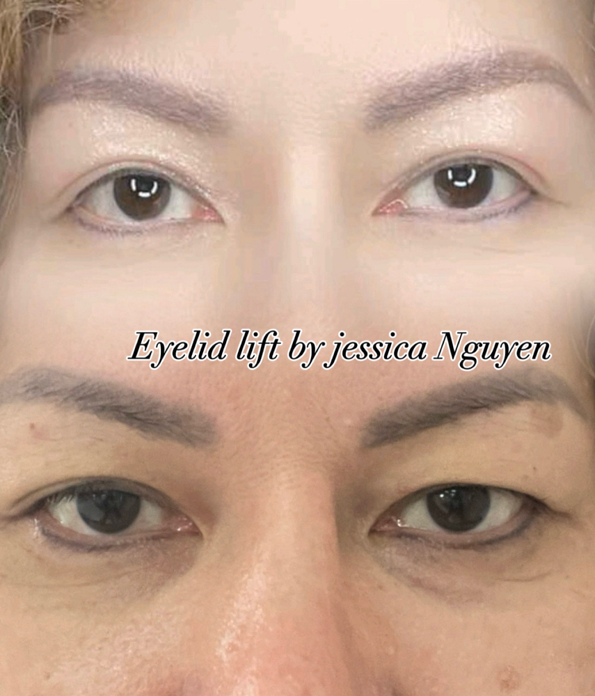 Eye Lid Lift