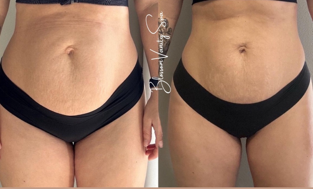 Radio Frequency Skin Tightening at Blossom Vanity Spa in Missouri City, TX