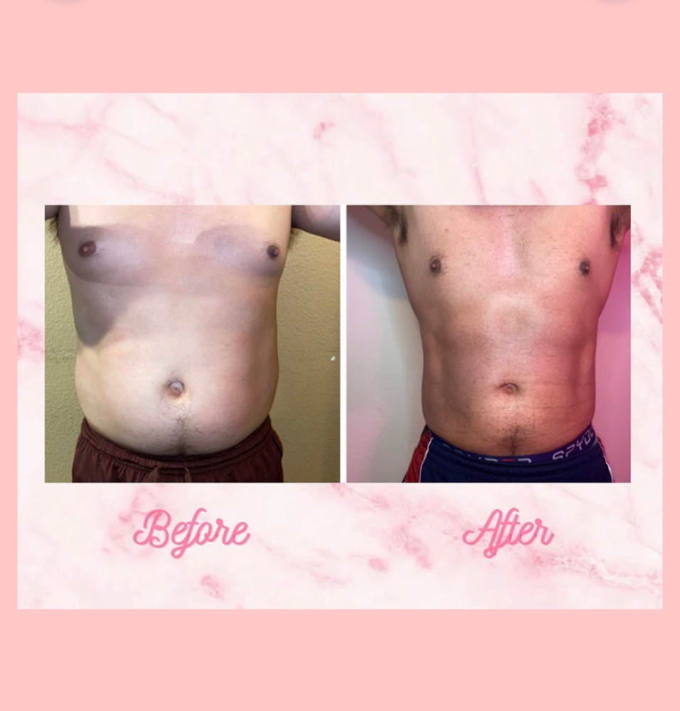 Lipo360 + Liposhots Whole Abdomen