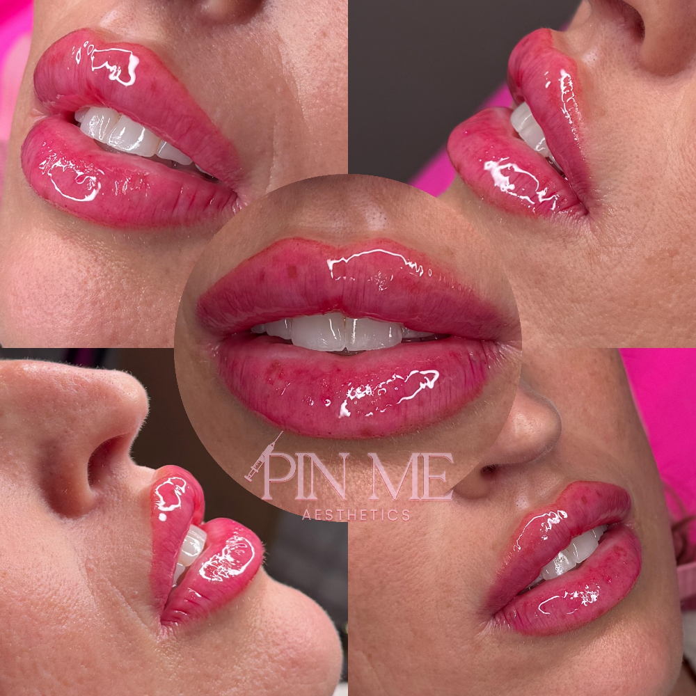 Full Syringe Lip Filler at Pin Me Aesthetics PLLC in Alvin, TX
