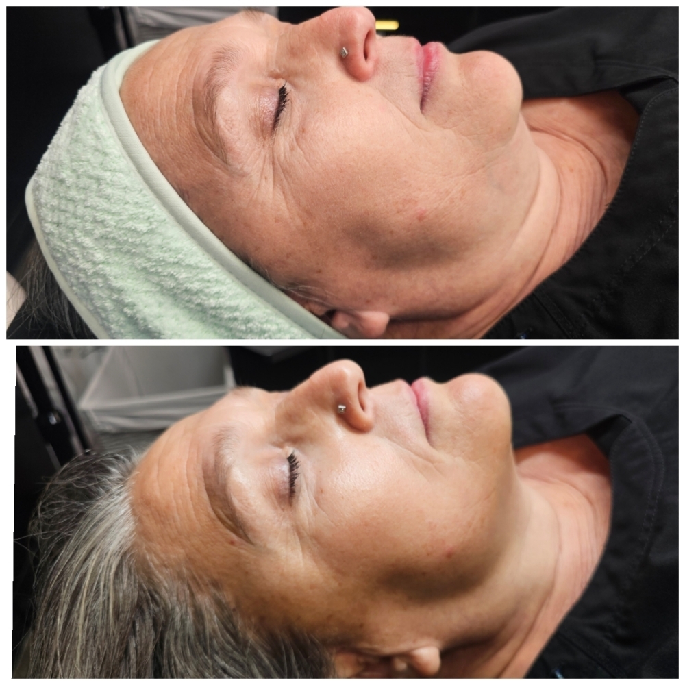 Microneedling + Dermaplaning Bundle at Tranquil Beauty LLC in South Jordan, UT