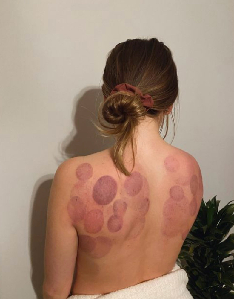 Back Cupping at Kacee Battreal - KB Beauty in Desloge, MO