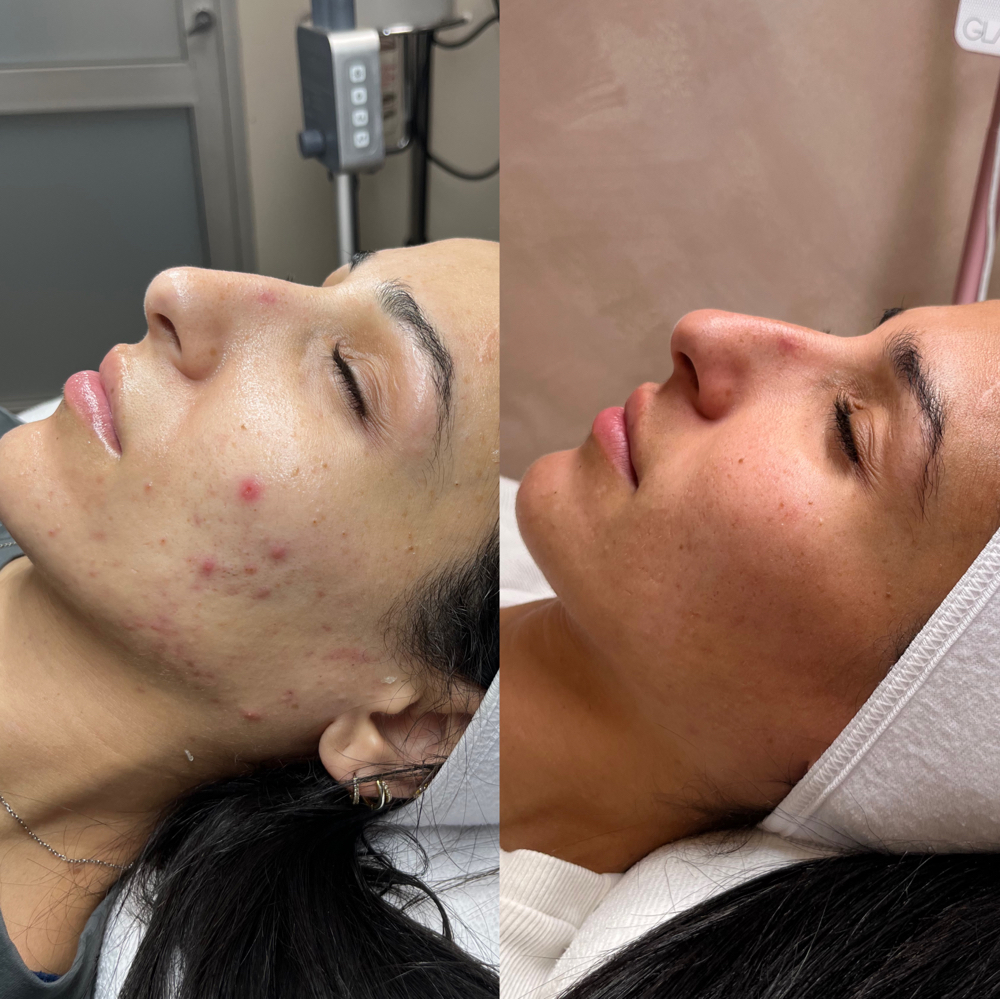 Acne Bootcamp