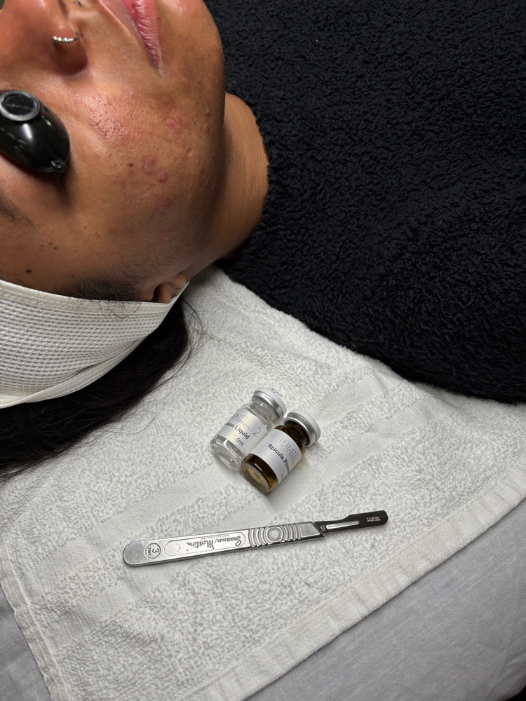 Biomicroneedling & Dermaplane