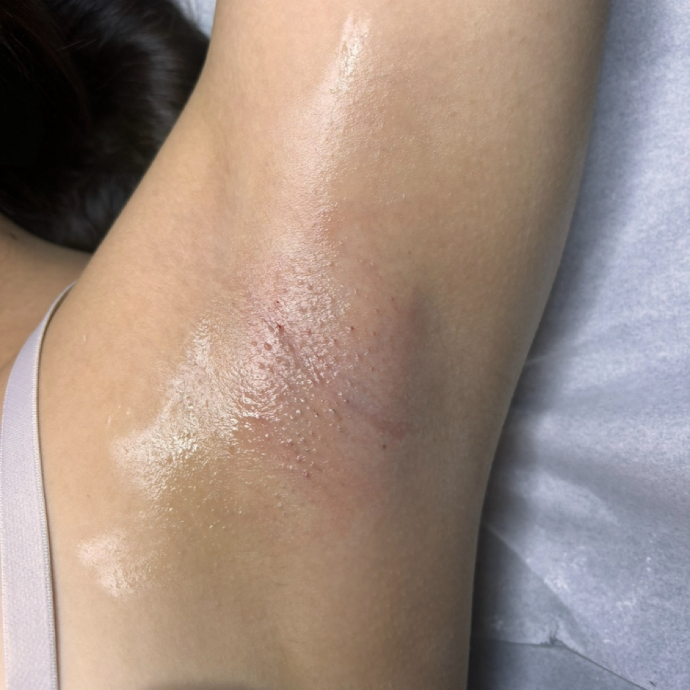 Under Arm Wax at Pearly Derm in Sun valley, CA