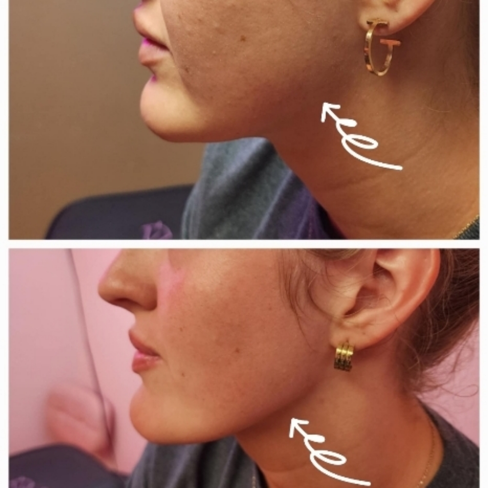 Masseters Botox at Lavish Luxuries in Lubbock, TX
