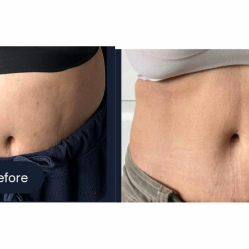 5 CRYO SLIMMING-Discounted Package at EllaSana Wellness and Cryotherapy in Watkinsville, GA