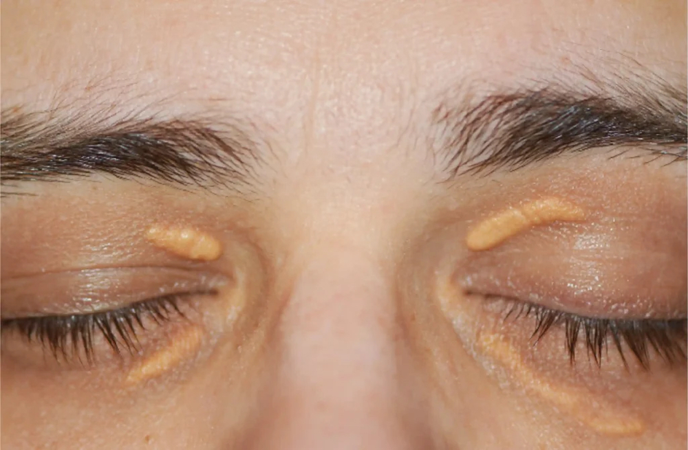 Xanthelasma Treatment
