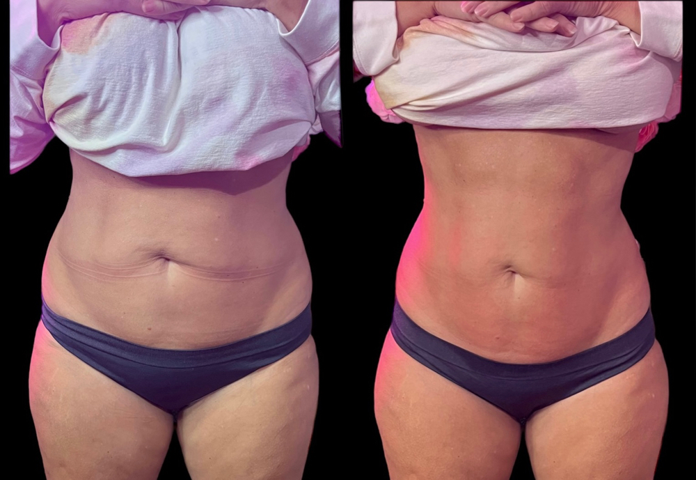 Lipo 360