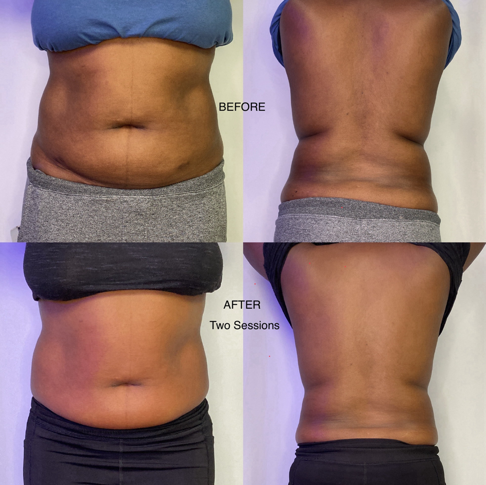 CryoSlimming - Large Area