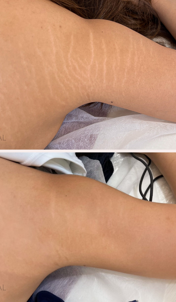 Stretch Mark Revise & Camouflage