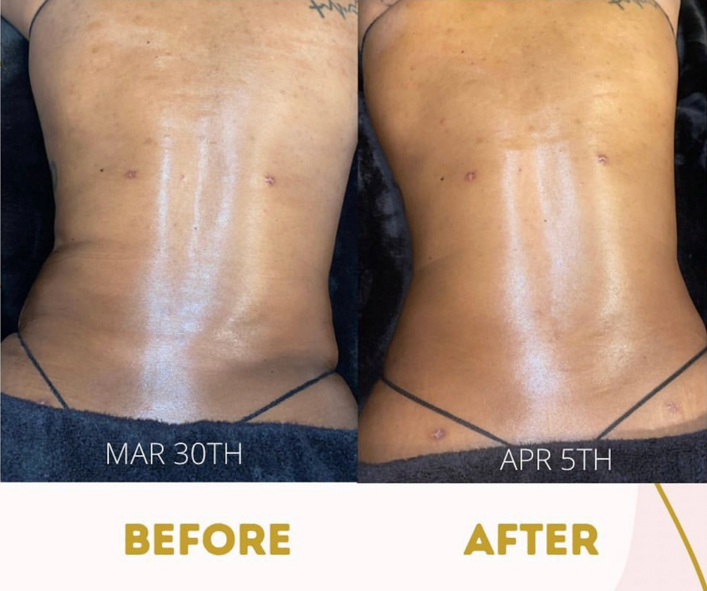 Lymphatic Drainage Massage