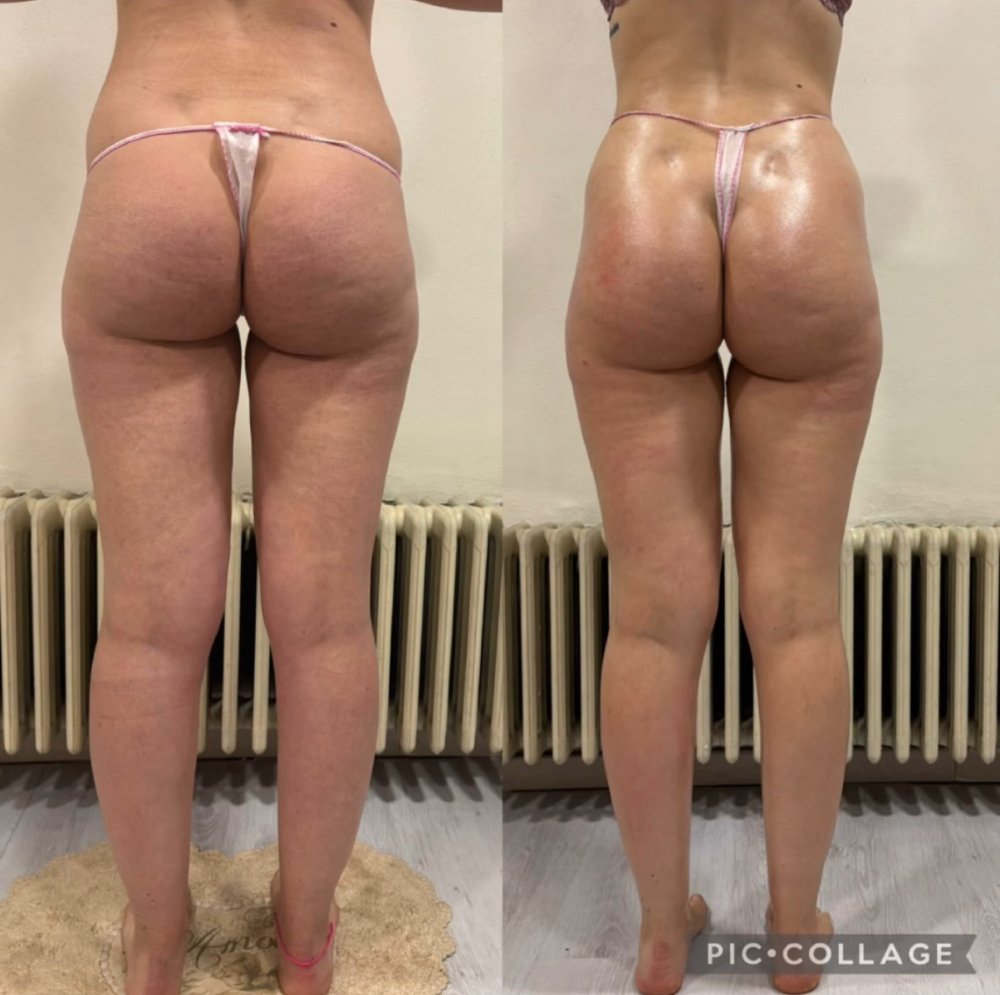 FAT BURNING / LOSS SKIN MACHINE