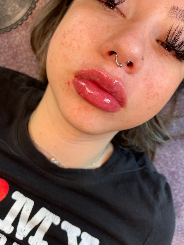 2.4 ML Lip Filler