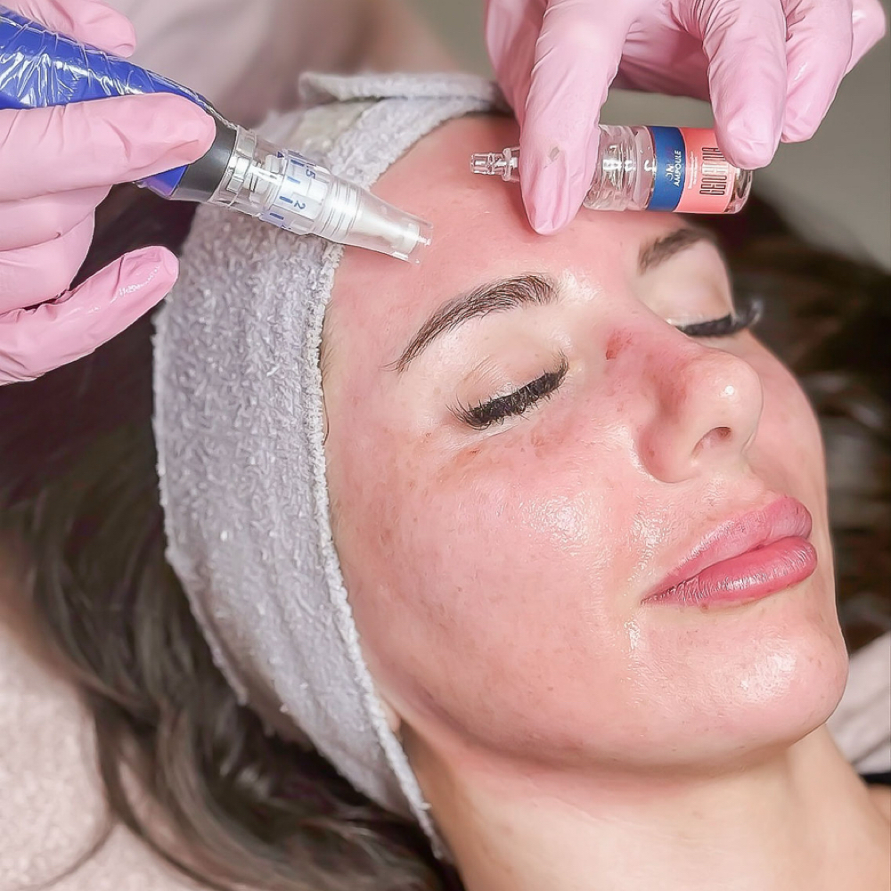 Microneedling at ARock Beauty & Wellness in San Angelo, TX