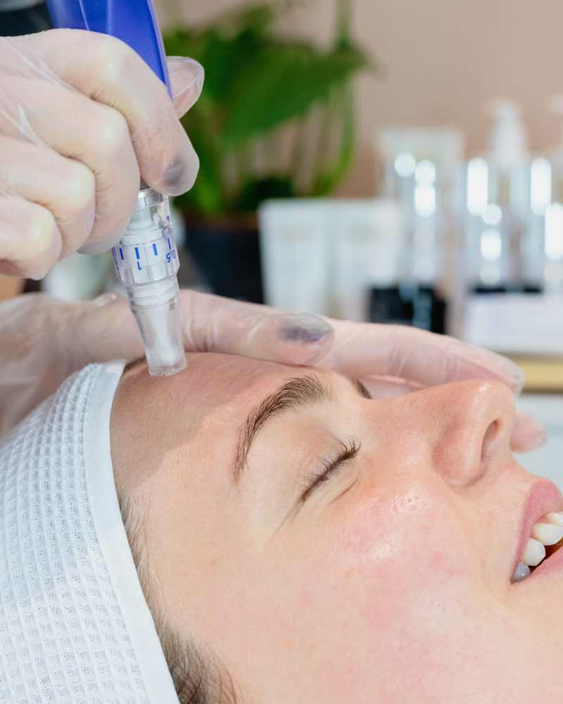 Microneedling