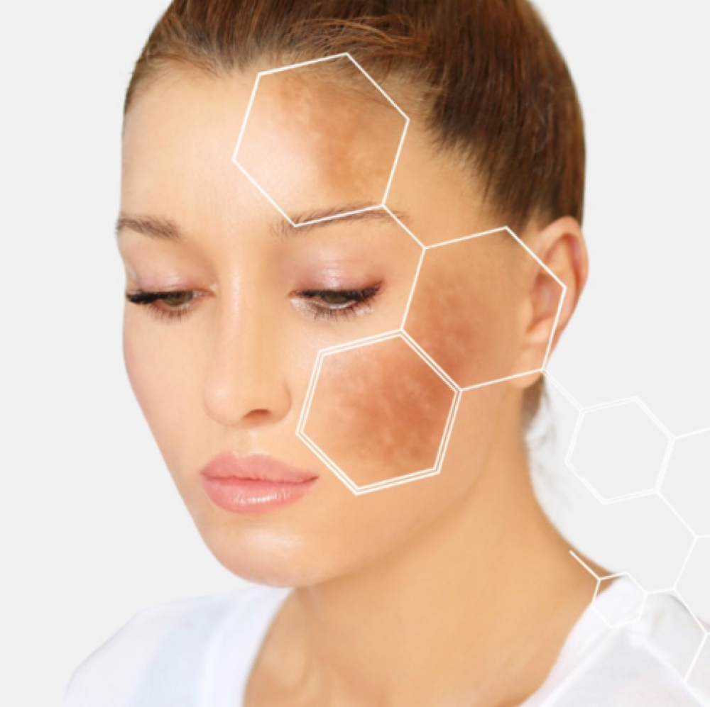 Dark Spots Laser(NY) at Holistic Beauty in View On Website, NY
