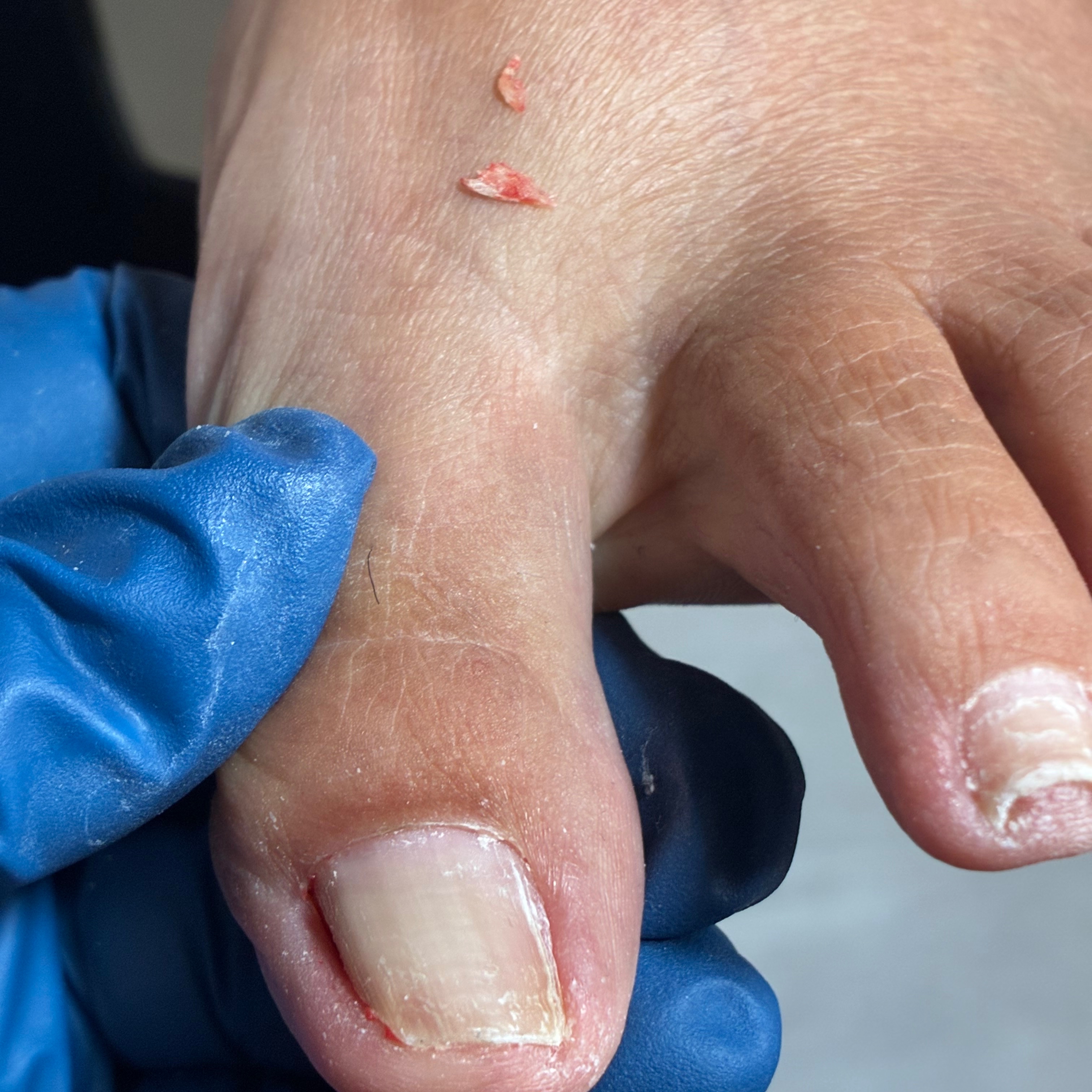 Ingrown Nail Care (Non-Surgical) at Zona Wellness in Redmond, OR