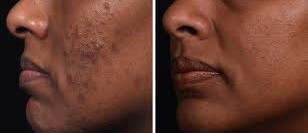 10% TCA Depigmentation Peel with 15